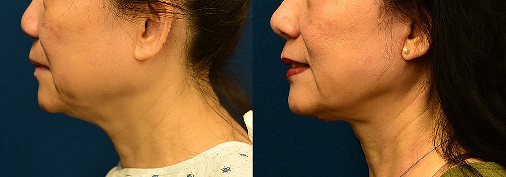 Rhinoplasty Before & After