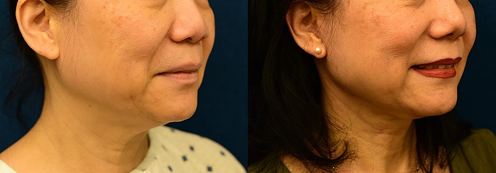 Rhinoplasty Before & After