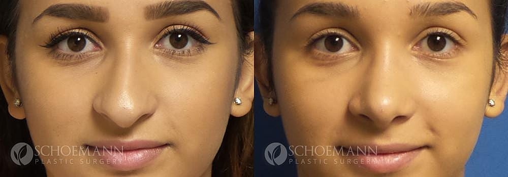Rhinoplasty Before & After