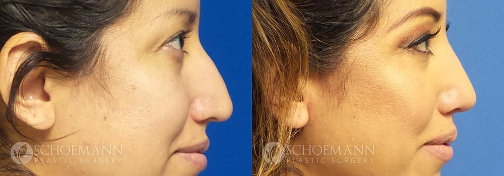 Rhinoplasty Before & After
