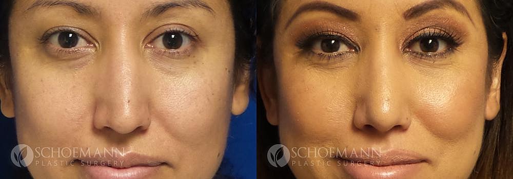 Rhinoplasty Before & After