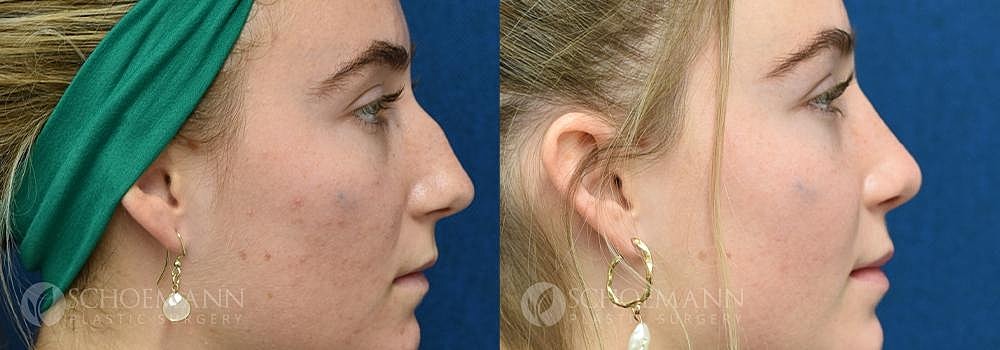 Rhinoplasty Before & After
