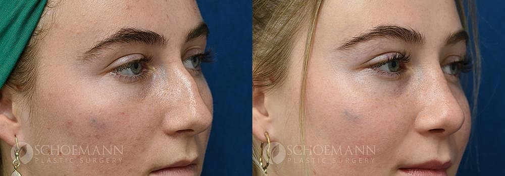 Rhinoplasty Before & After