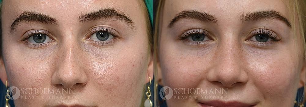 Rhinoplasty Before & After