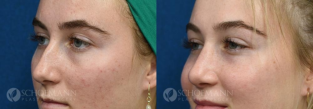 Rhinoplasty Before & After