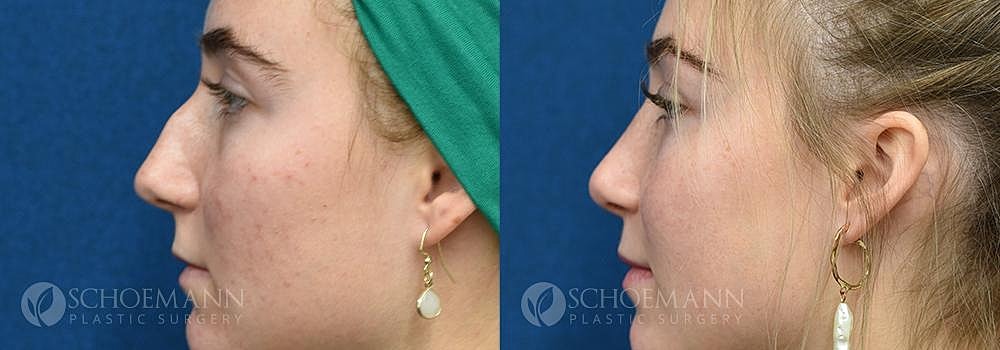 Rhinoplasty Before & After