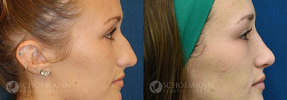 Rhinoplasty Before & After