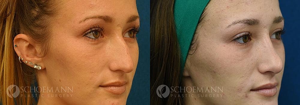 Rhinoplasty Before & After