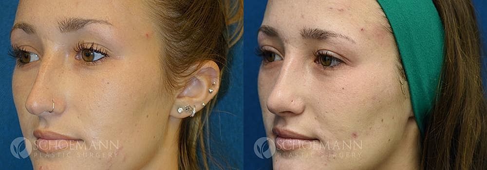 Rhinoplasty Before & After