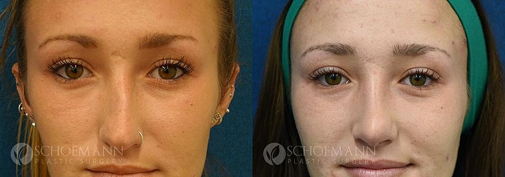 Rhinoplasty Before & After