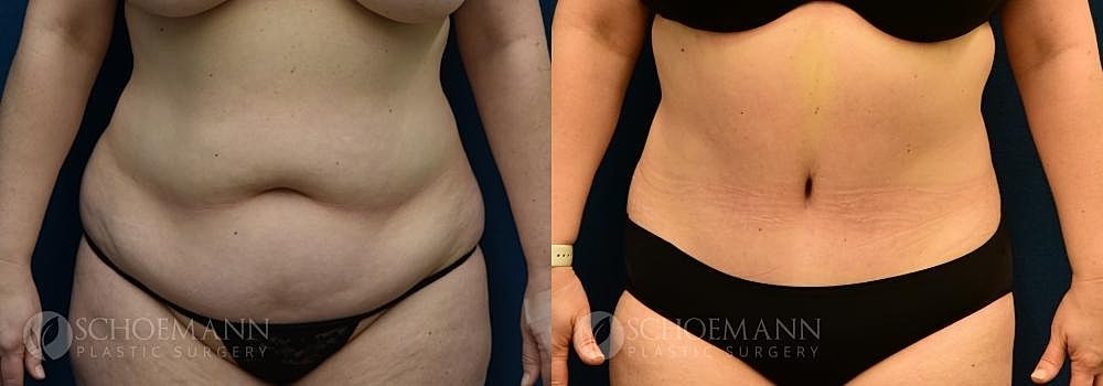 Tummy Tuck Before & After
