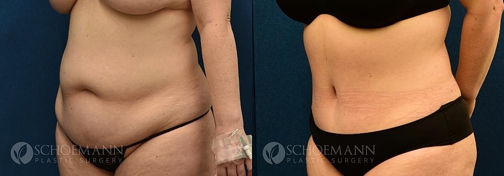 Tummy Tuck Before & After