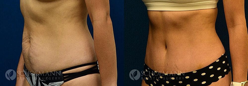 Tummy Tuck Before & After