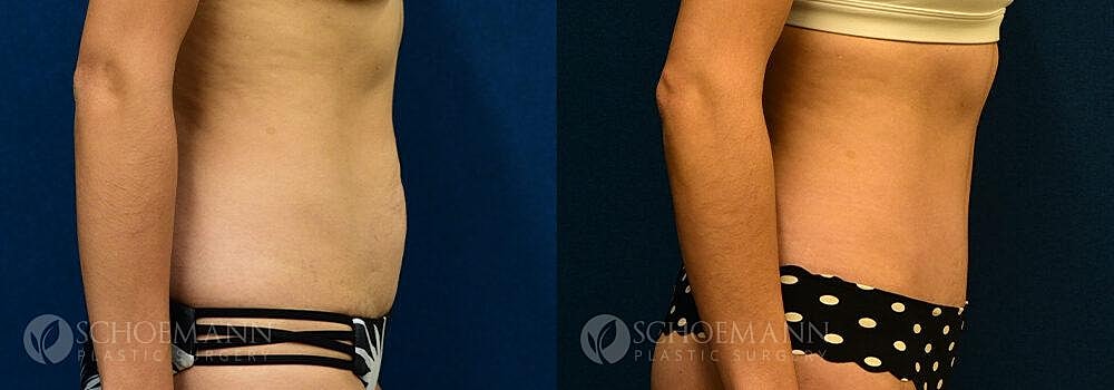 Tummy Tuck Before & After