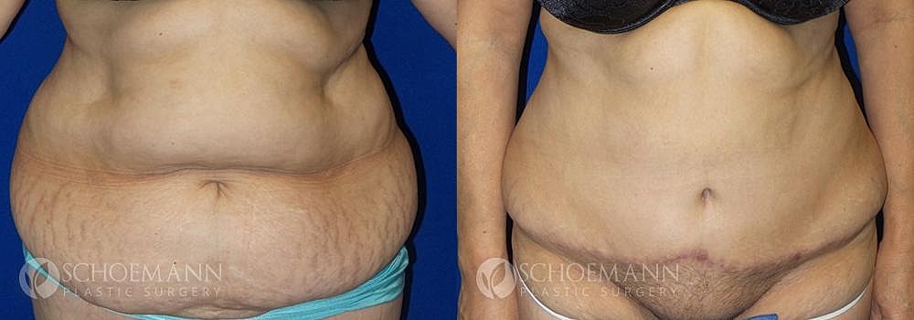 Tummy Tuck Before & After