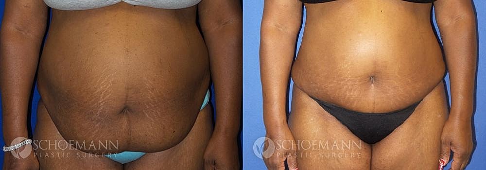Tummy Tuck Before & After