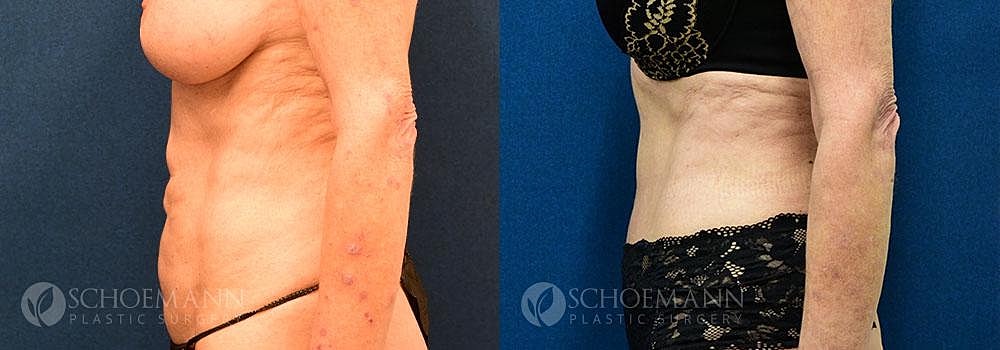 Tummy Tuck Before & After