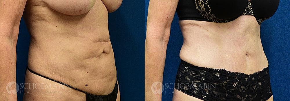Tummy Tuck Before & After