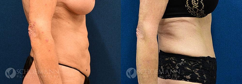 Tummy Tuck Before & After