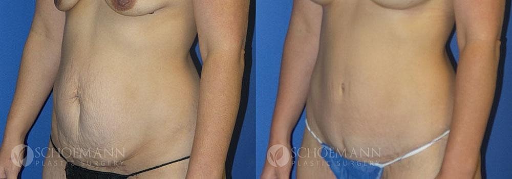 Tummy Tuck Before & After