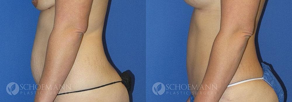 Tummy Tuck Before & After