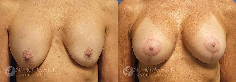 Breast Augmentation and Lift Before & After