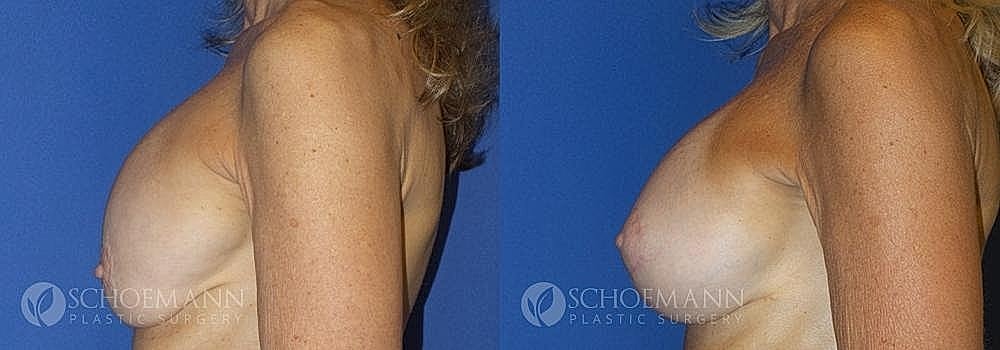 Breast Augmentation and Lift Before & After